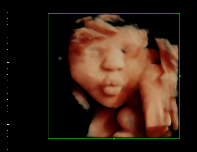 3D ultrasound image at 33 weeks